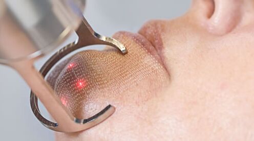 Przebieg zabiegu frakcyjnego laserowego odmładzania skóry twarzy