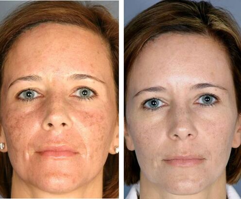 Przed i po frakcyjnej termolizie twarzy