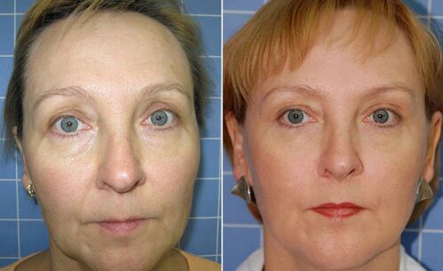 Przed i po frakcyjnym laserowym odmładzaniu twarzy