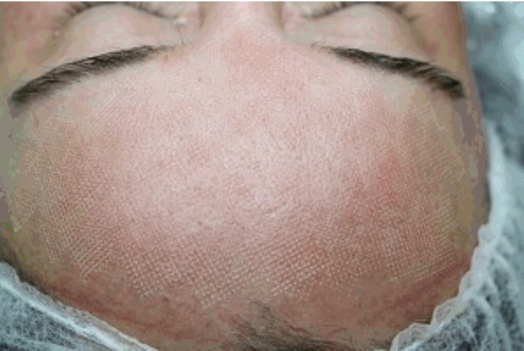 Zaczerwienienie i lekki obrzęk skóry po zastosowaniu lasera frakcyjnego