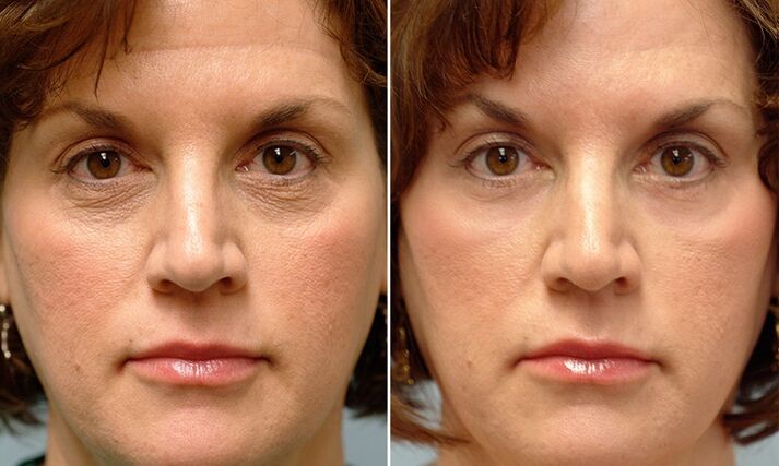 twarz przed i po laserowym odmładzaniu frakcyjnym